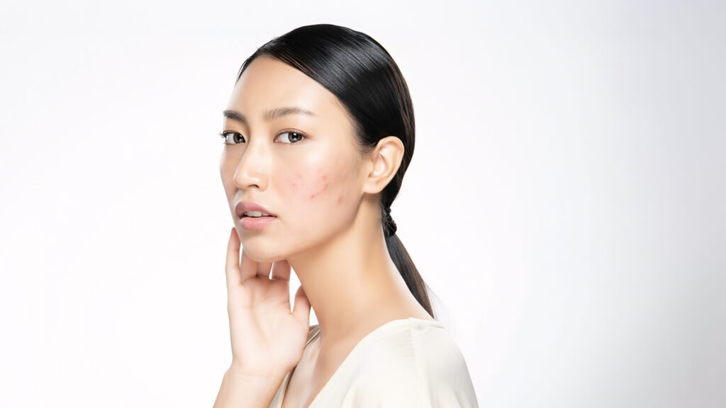 Breakout dipicu dari kondisi wajah yang tidak bersih di malam hari